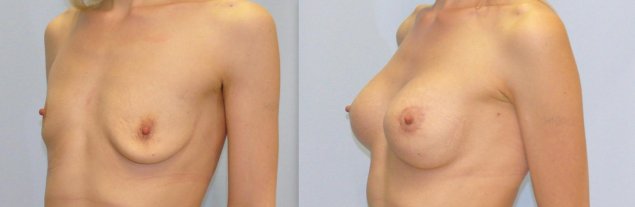 Увеличение груди операция