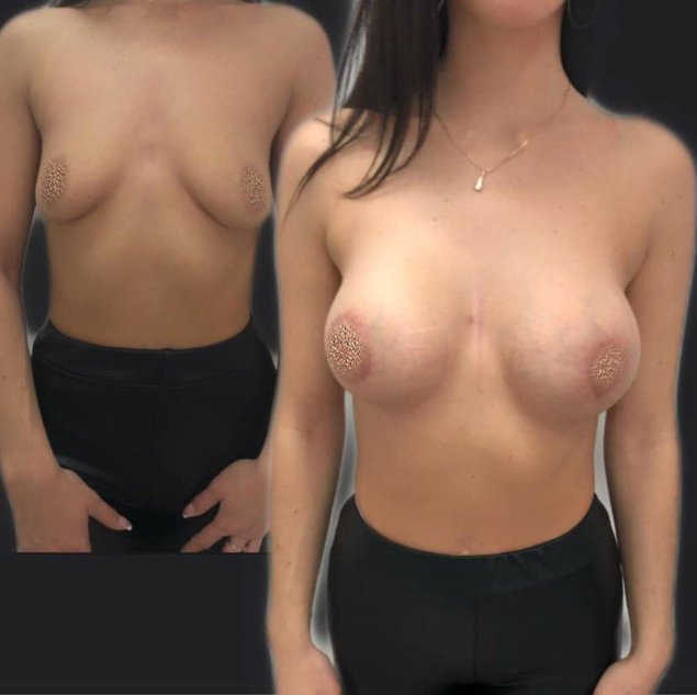 Пластика груди