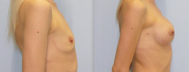 Увеличение грудных желез