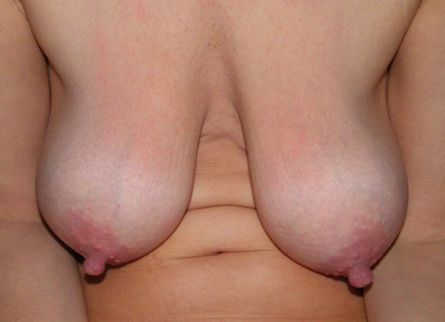 Отвисшая грудь